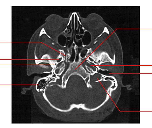 skull ct